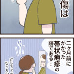 帯状疱疹、顔にできるなんて聞いてない！①